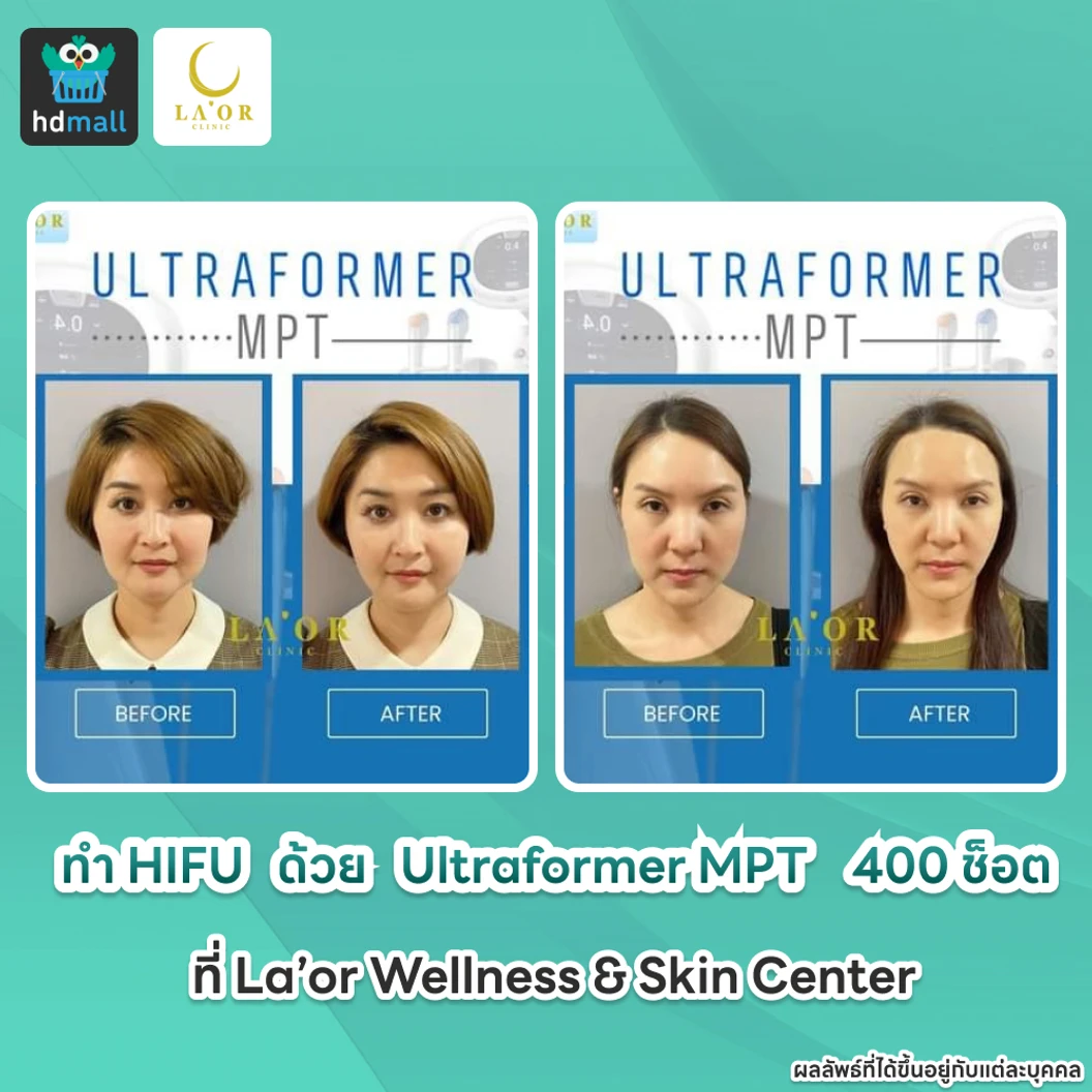 ทำ HIFU ด้วยเครื่อง Ultraformer MPT 400 ช็อต ยกกระชับบริเวณทั่วใบหน้าและเหนียง 1 ครั้ง ที่ La’or Wellness & Skin Center