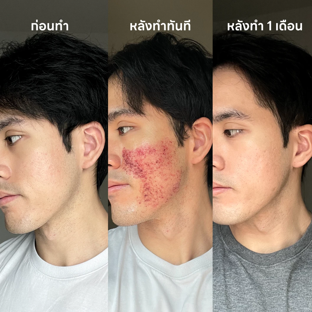 Discovery Pico เลเซอร์หน้าเพื่อผิวเรียบเนียน หลุมสิวตื้นขึ้น 1 ครั้ง ที่ Dermatiks Clinic