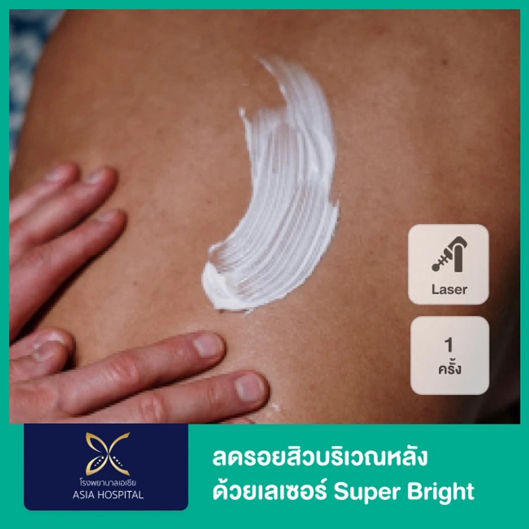 ลดรอยสิวบริเวณหลัง ด้วยเลเซอร์ Super Bright 1 ครั้ง ที่ โรงพยาบาลเอเซีย