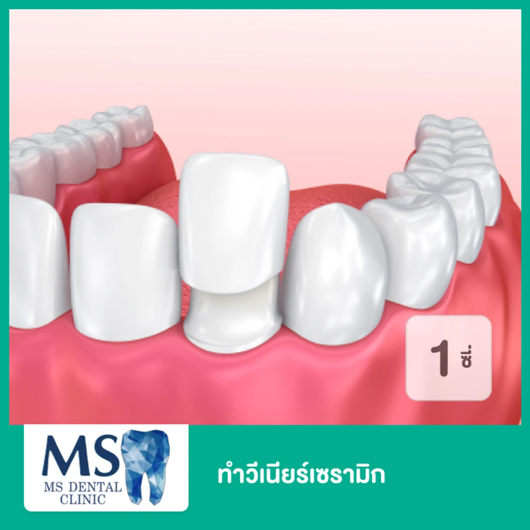 ทำวีเนียร์เซรามิก สำหรับฟัน 1 ซี่ ที่ MS Dental Clinic เอ็มเอสคลินิกทันตกรรม สุขุมวิท 39