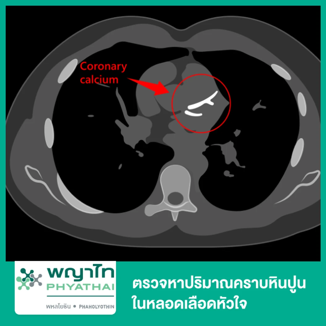 ตรวจหาปริมาณคราบหินปูนในหลอดเลือดหัวใจ Calcium Scoring ด้วยเครื่อง CT Scan ที่ โรงพยาบาลพญาไท พหลโยธิน