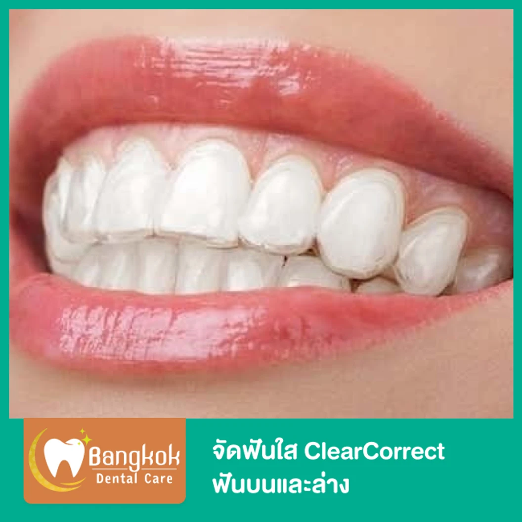 จัดฟันใส ClearCorrect ฟันบนและล่าง ที่ Bangkok Dental Care