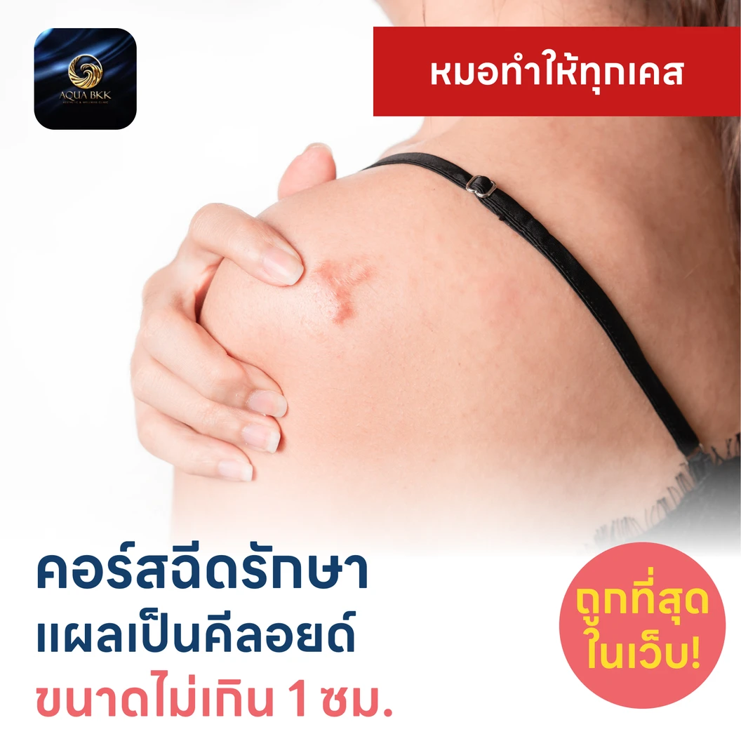 คอร์สฉีดรักษาแผลเป็นคีลอยด์ ขนาดเส้นผ่านศูนย์กลางไม่เกิน 1 ซม. 1 จุด 5 ครั้ง แพ็กเกจ HDmall+ ที่ AQUA BKK Aesthetic & Wellness Clinic