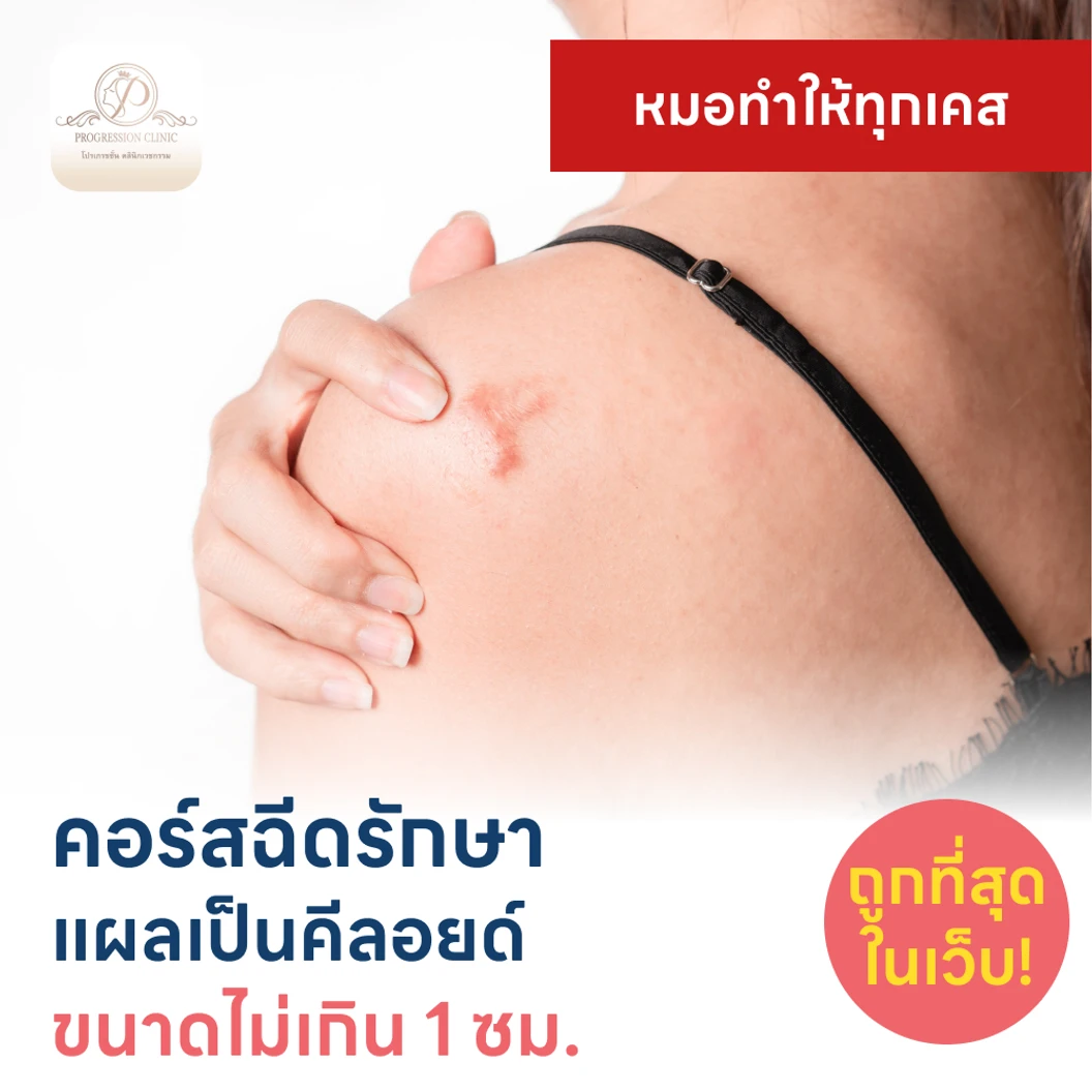 คอร์สฉีดรักษาแผลเป็นคีลอยด์ ขนาดเส้นผ่านศูนย์กลางไม่เกิน 1 ซม 1 จุด 5 ครั้ง แพ็กเกจ HDmall+ ที่ Progression Clinic