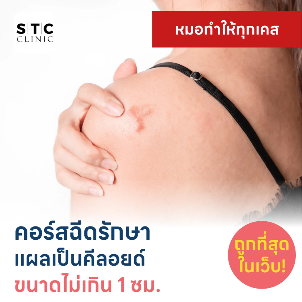 คอร์สฉีดรักษาแผลเป็นคีลอยด์ ขนาดเส้นผ่านศูนย์กลางไม่เกิน 1 ซม 1 จุด 5 ครั้ง แพ็กเกจ HDmall+ ที่ STC Anti-Aging & Wellness Clinic
