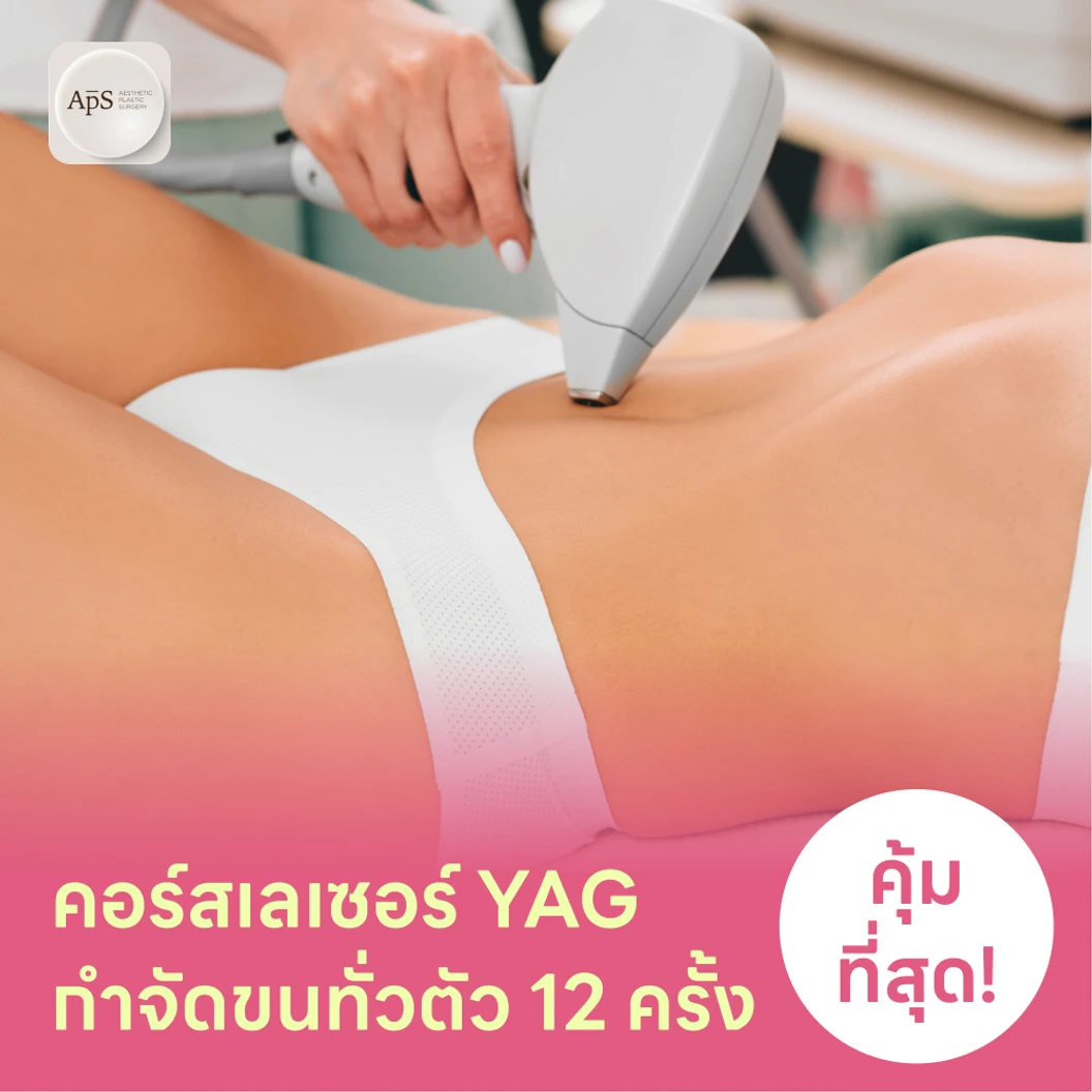 คอร์สเลเซอร์กำจัดขนเหมาทั่วตัว 12 ครั้ง ด้วย YAG Laser แพ็กเกจ HDmall+ ที่ APS Clinic