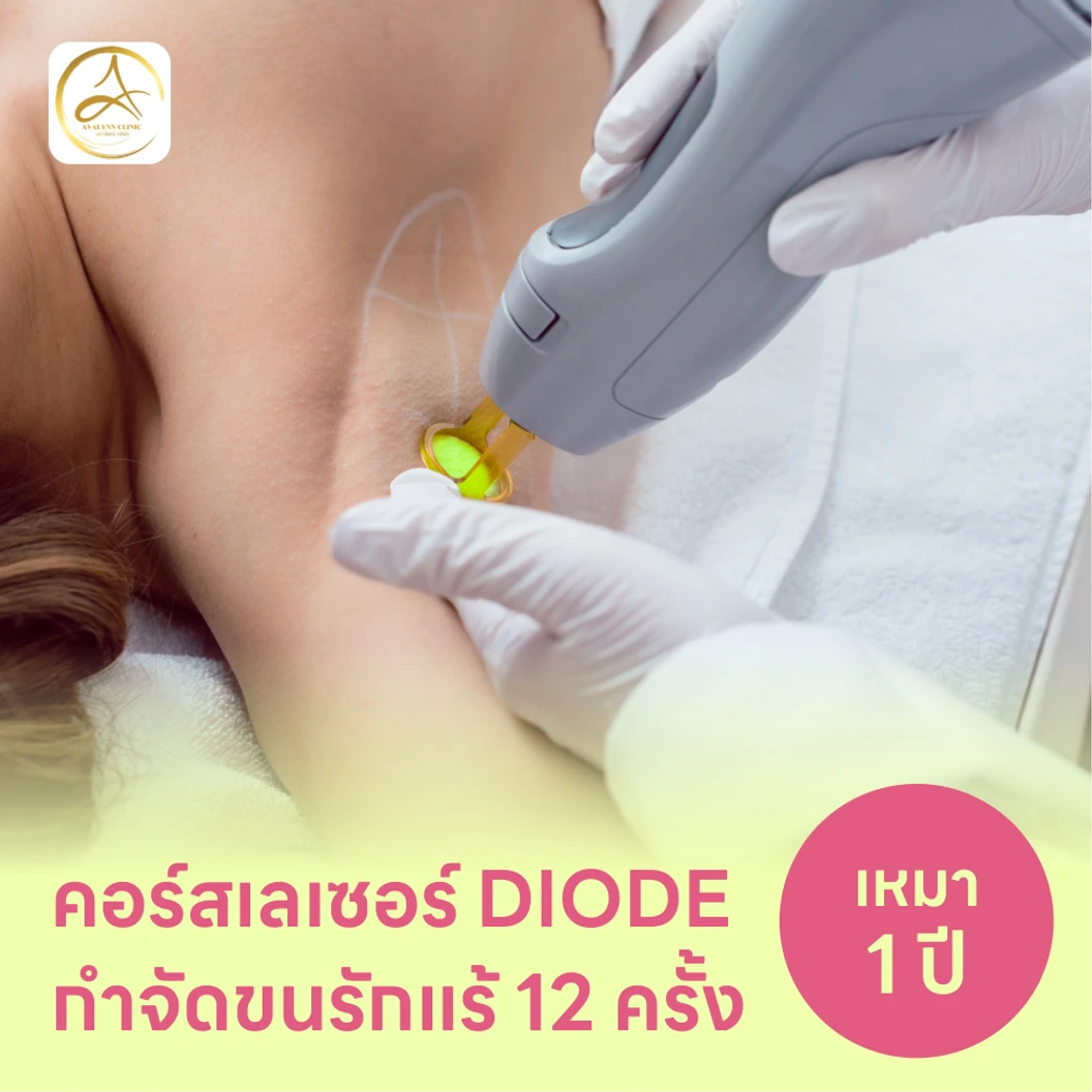 คอร์สเลเซอร์กำจัดขนรักแร้ 12 ครั้ง ด้วย Diode Laser แพ็กเกจ HDmall+ ที่ Avalynn Clinic เอวาลิลณ์ คลินิกเวชกรรม