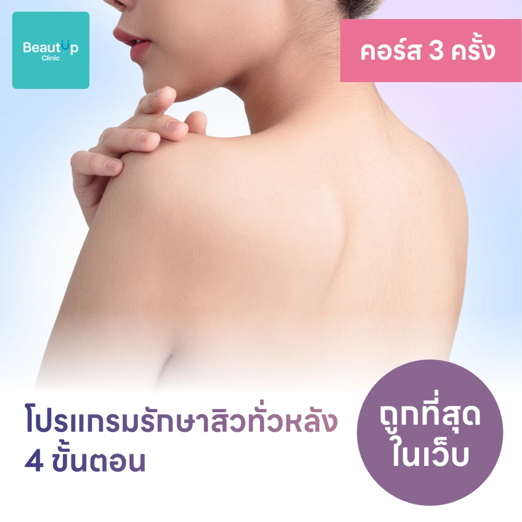 คอร์สโปรแกรมรักษาสิวทั่วแผ่นหลัง 4 ขั้นตอน 2 ครั้ง ฟรี! 1 ครั้ง แพ็กเกจ HDmall+ ที่ BeautUp Clinic บิวท์อัพคลินิกเวชกรรม