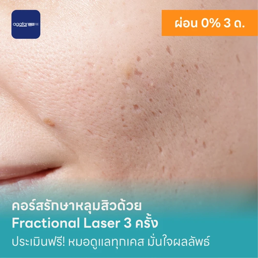 คอร์สรักษาหลุมสิวด้วย Fractional Laser 3 ครั้ง แพ็กเกจ HDmall+ ที่ Agafar Medical Clinic