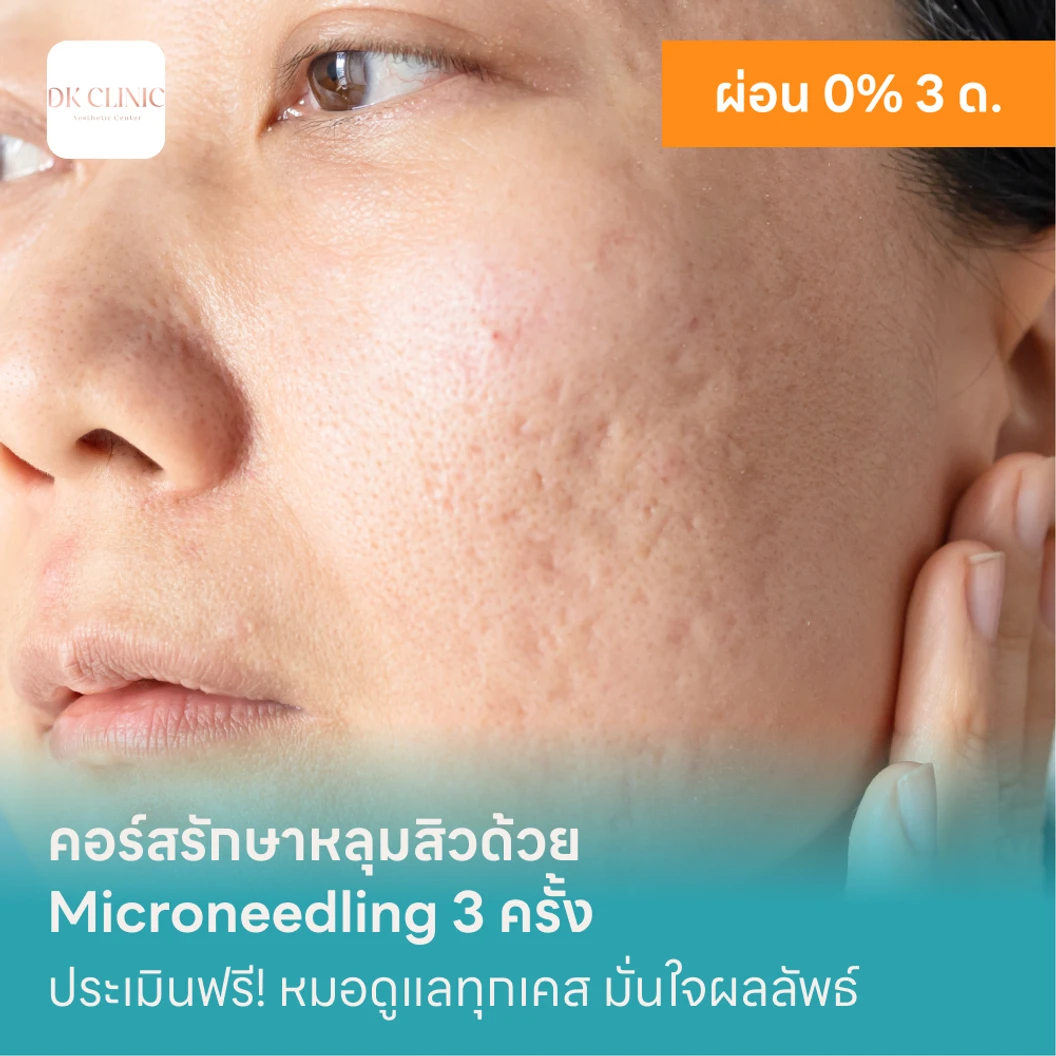 คอร์สรักษาหลุมสิวด้วย Microneedling 3 ครั้ง แพ็กเกจ HDmall+ ที่ DK Clinic