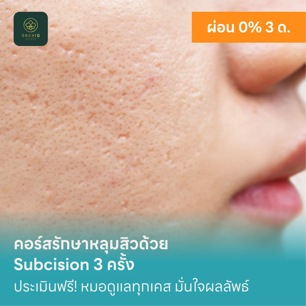 คอร์สรักษาหลุมสิวด้วย Subcision 3 ครั้ง แพ็กเกจ HDmall+ ที่ Orchid Clinic