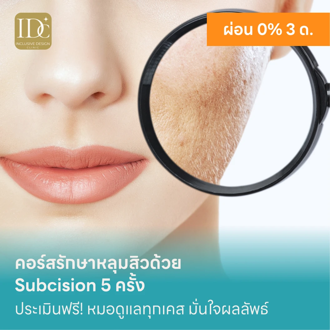 คอร์สรักษาหลุมสิวด้วย Subcision 5 ครั้ง แพ็กเกจ HDmall+ ที่ IDC Clinic