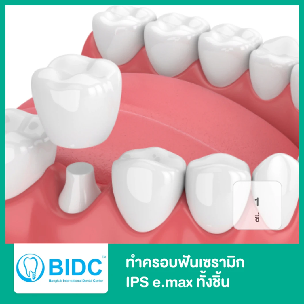 ทำครอบฟันเซรามิก IPS E.Max ทั้งชิ้น 1 ซี่ ที่ BIDC Dental Center BIDC