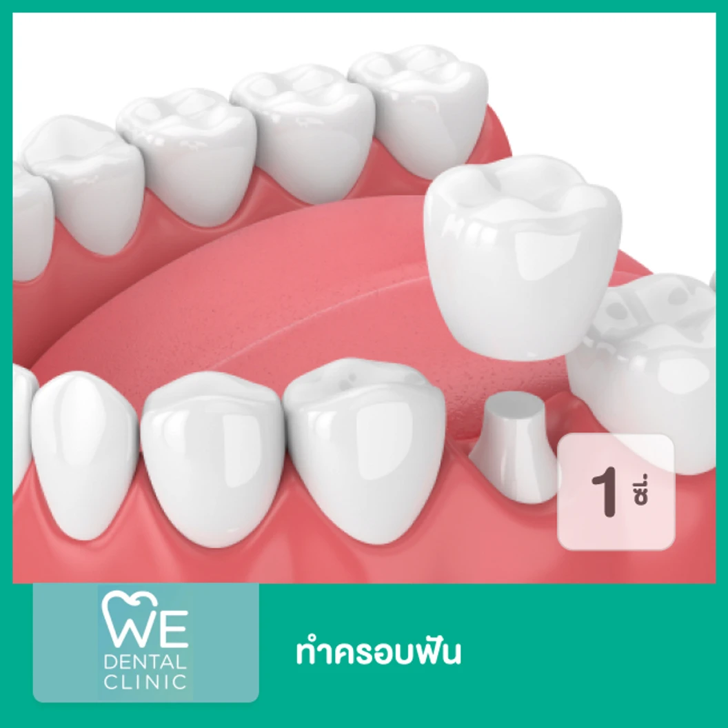 ทำครอบฟัน 1 ซี่ ที่ WE Dental Clinic