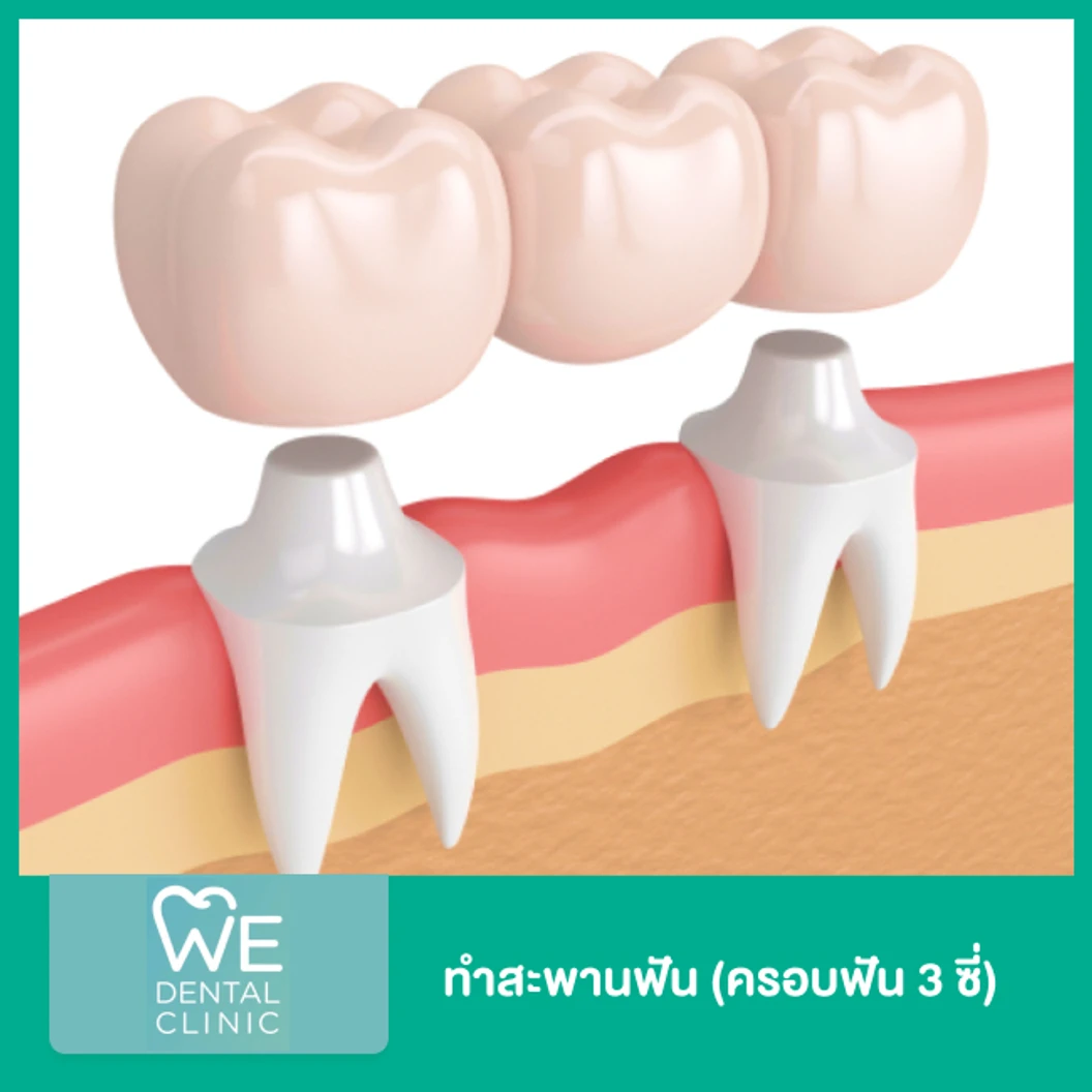 ทำสะพานฟัน ครอบฟัน 3 ซี่ ที่ WE Dental Clinic
