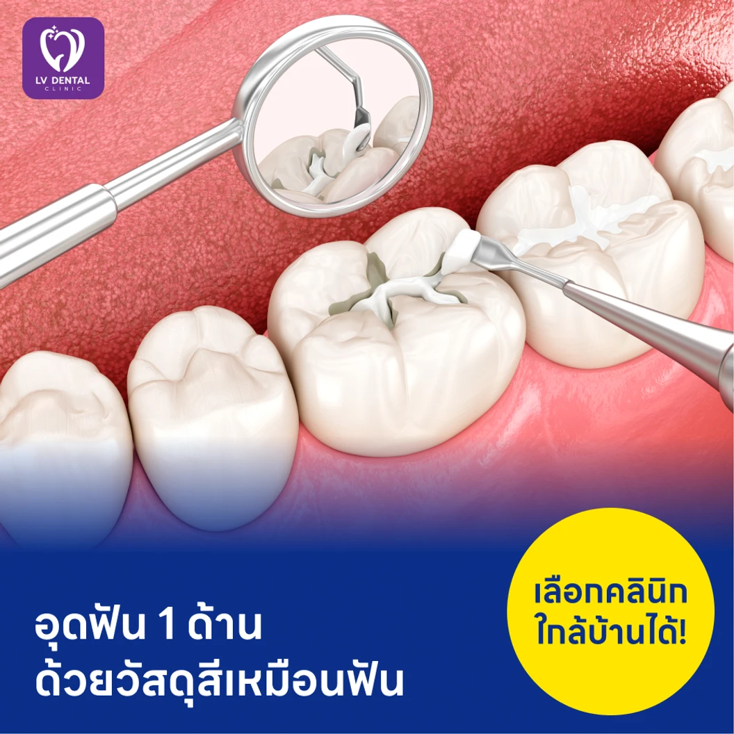 อุดฟัน 1 ด้าน ด้วยวัสดุสีเหมือนฟัน แพ็กเกจ HDmall+ ที่ LV Dental Clinic แอลวีเด็นทัล รัชดา 48
