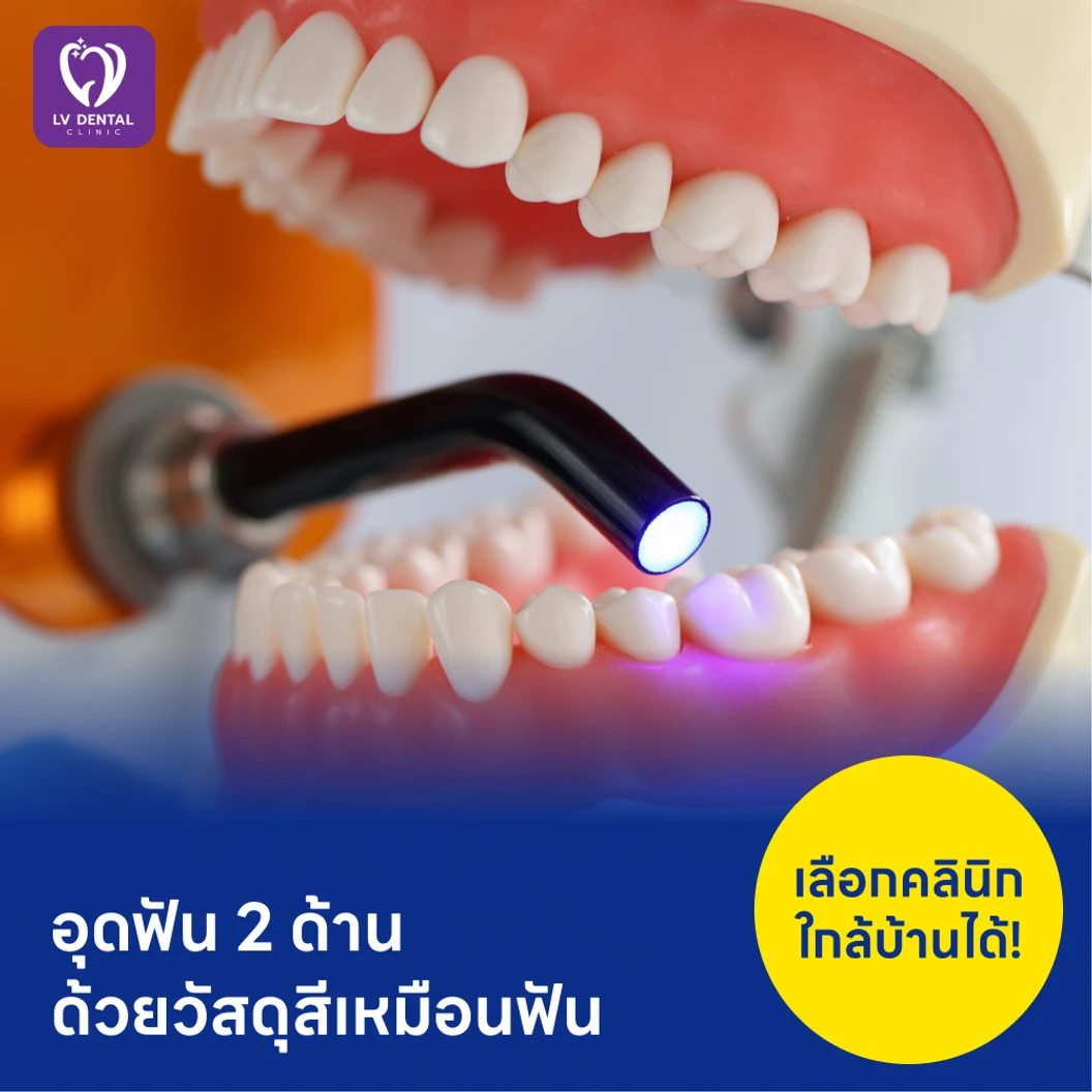 อุดฟัน 2 ด้าน ด้วยวัสดุสีเหมือนฟัน แพ็กเกจ HDmall+ ที่ LV Dental Clinic แอลวีเด็นทัล รัชดา 48