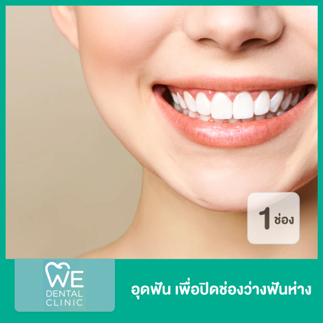 อุดฟัน เพื่อปิดช่องว่างฟันห่าง 1 ช่อง ที่ WE Dental Clinic