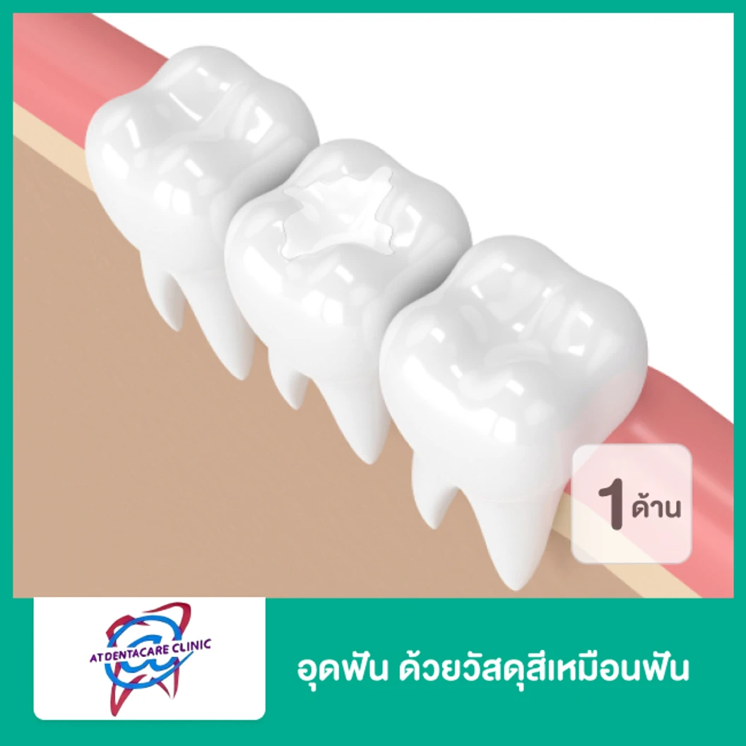 อุดฟัน ด้วยวัสดุสีเหมือนฟัน 1 ด้าน ที่ แอทเดนต้าแคร์ คลินิกทันตกรรม