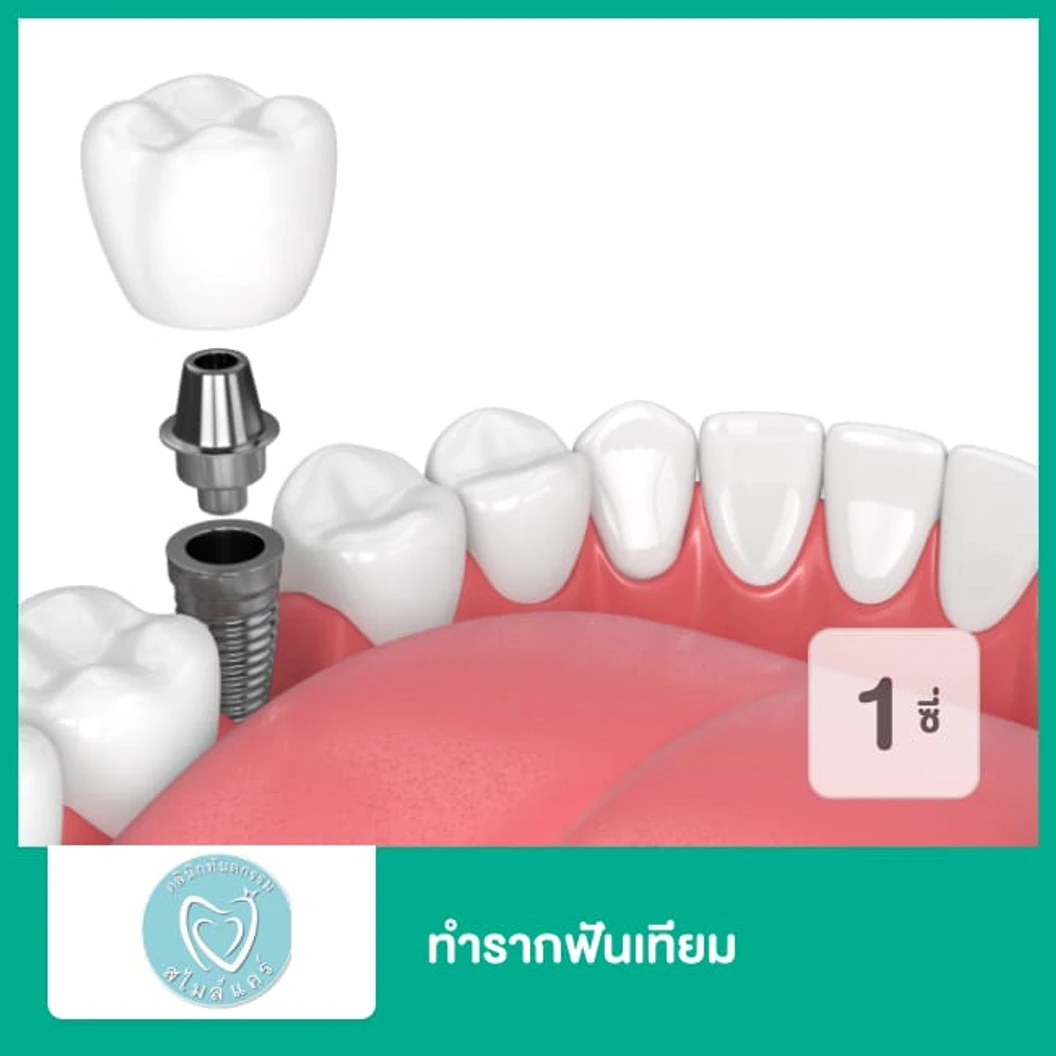 ทำรากฟันเทียม ยี่ห้อ Osstem สำหรับฟัน 1 ซี่ ที่ คลินิกทันตกรรมสไมล์แคร์ สมุทรปราการ
