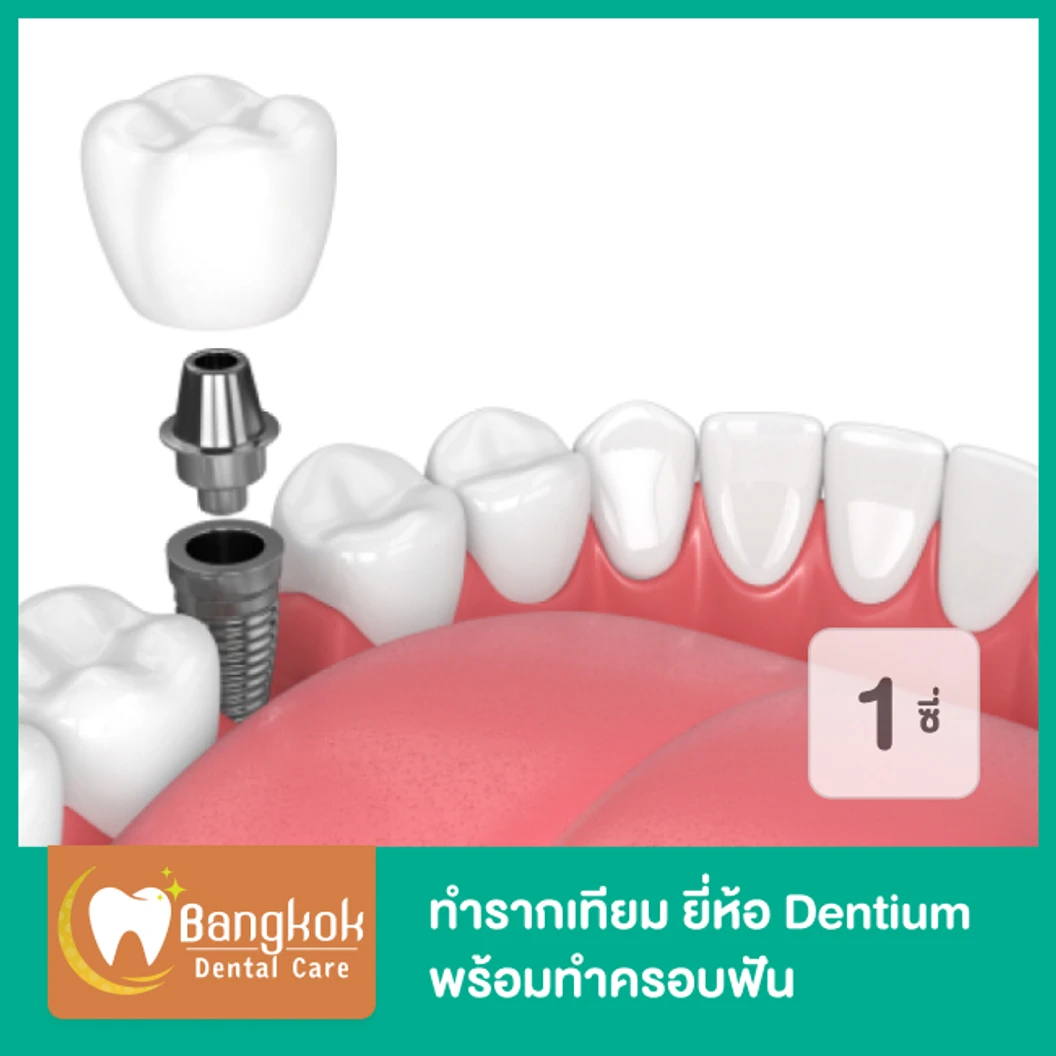 ทำรากฟันเทียม ยี่ห้อ Dentium พร้อมทำครอบฟัน สำหรับฟัน 1 ซี่ ที่ Bangkok Dental Care