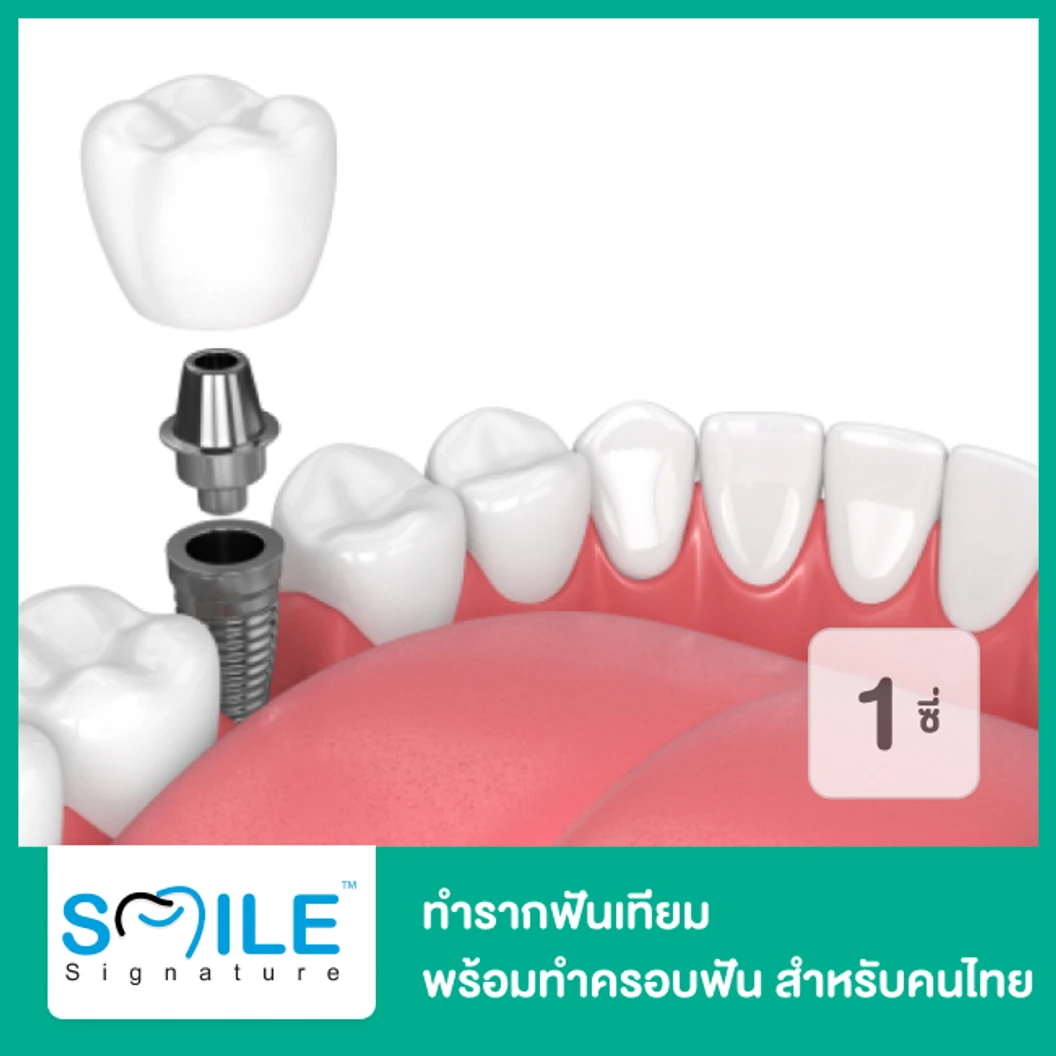 ทำรากฟันเทียม ยี่ห้อ P-I พร้อมทำครอบฟัน สำหรับฟัน 1 ซี่ สำหรับคนไทย ที่ Smile Signature คลินิกทันตกรรมสไมล์ ซิกเนเจอร์