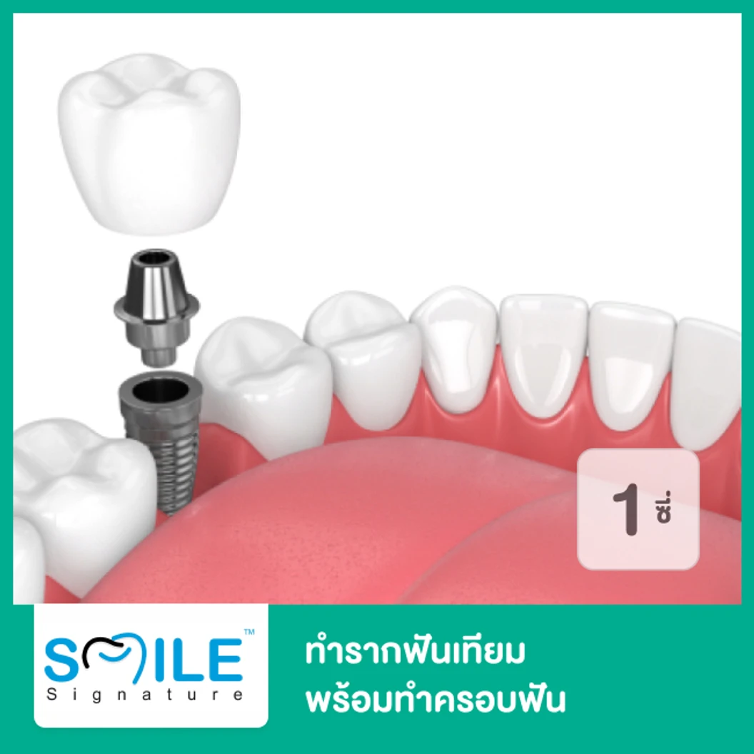 ทำรากฟันเทียม ยี่ห้อ Straumann SLA พร้อมทำครอบฟัน สำหรับฟัน 1 ซี่ ที่ Smile Signature คลินิกทันตกรรมสไมล์ ซิกเนเจอร์