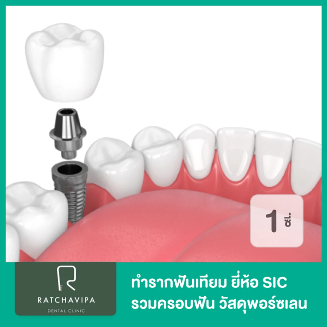 ทำรากฟันเทียม ยี่ห้อ SIC รวมครอบฟัน วัสดุพอร์ซเลน สำหรับฟัน 1 ซี่ ที่ Ratchavipa Dental Clinic คลินิกทันตกรรมรัชวิภา