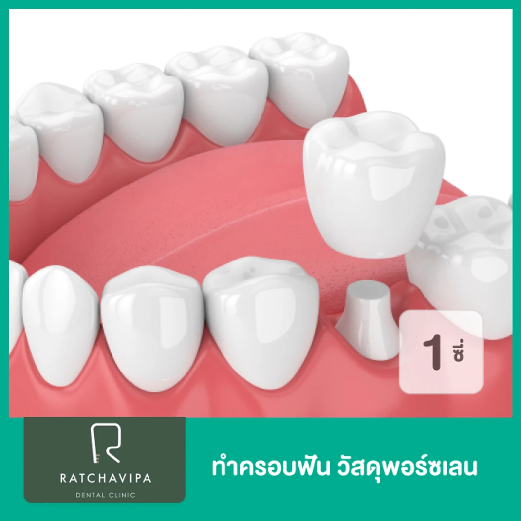 ทำครอบฟัน วัสดุพอร์ซเลน สำหรับฟัน 1 ซี่ ที่ Ratchavipa Dental Clinic คลินิกทันตกรรมรัชวิภา