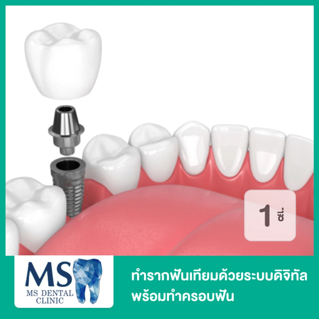 ทำรากฟันเทียมด้วยระบบดิจิทัล ยี่ห้อ Dentium พร้อมทำครอบฟันด้วยวัสดุสีเหมือนฟัน 1 ซี่ ที่ MS Dental Clinic เอ็มเอสคลินิกทันตกรรม สุขุมวิท 39