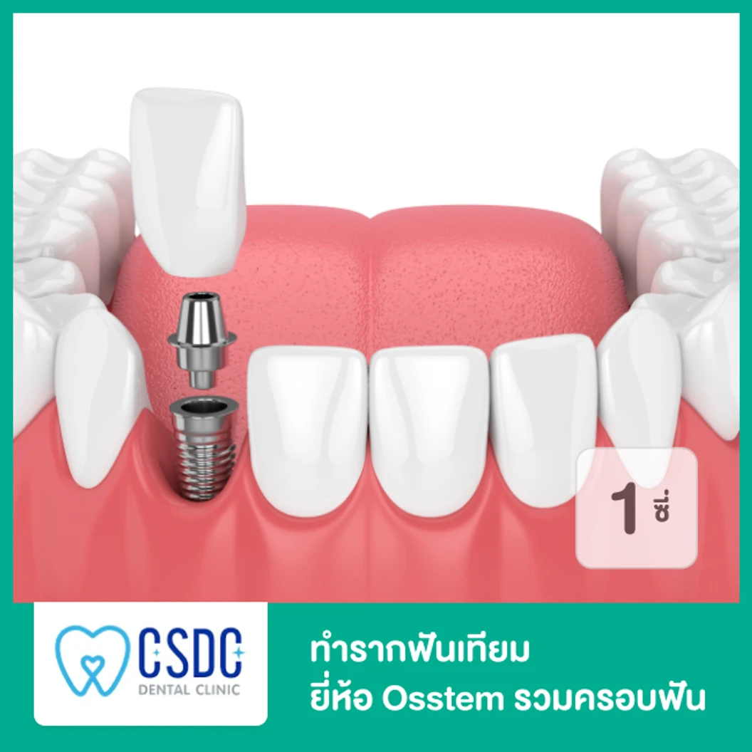 ทำรากฟันเทียม ยี่ห้อ Osstem รวมครอบฟัน 1 ซี่ ที่ CSDC