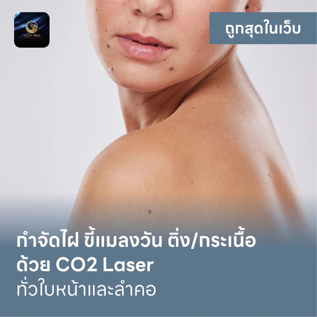 กำจัดไฝ ขี้แมลงวัน ติ่งเนื้อ กระเนื้อ ด้วย CO2 Laser ขนาดเส้นผ่านศูนย์กลางไม่เกิน 2 มม ไม่จำกัดจุดทั่วใบหน้าและลำคอ 1 ครั้ง แพ็กเกจ HDmall+ ที่ AQUA BKK Aesthetic & Wellness Clinic