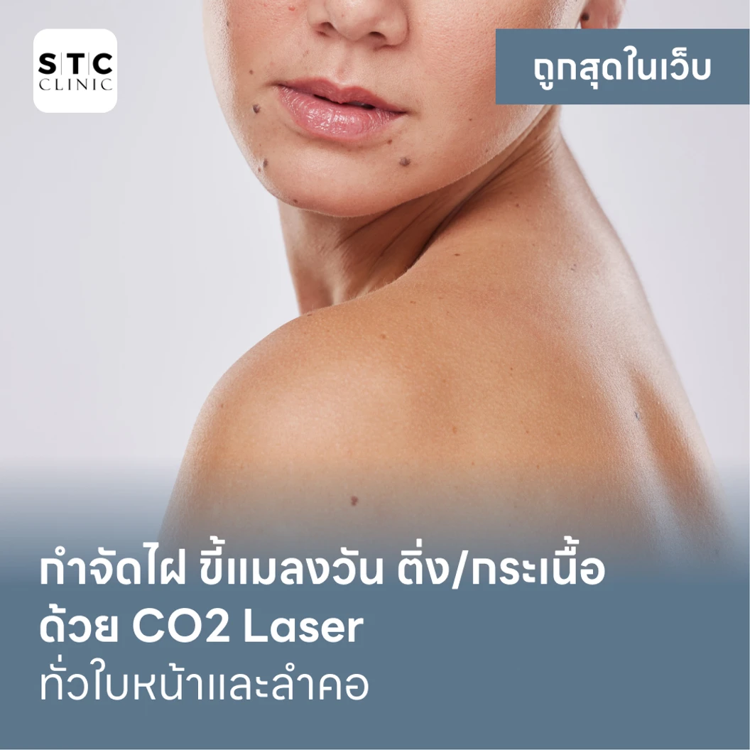 กำจัดไฝ ขี้แมลงวัน ติ่งเนื้อ กระเนื้อ ด้วย CO2 Laser ขนาดเส้นผ่านศูนย์กลางไม่เกิน 2 มม ไม่จำกัดจุดทั่วใบหน้าและลำคอ 1 ครั้ง แพ็กเกจ HDmall+ ที่ STC Anti-Aging & Wellness Clinic
