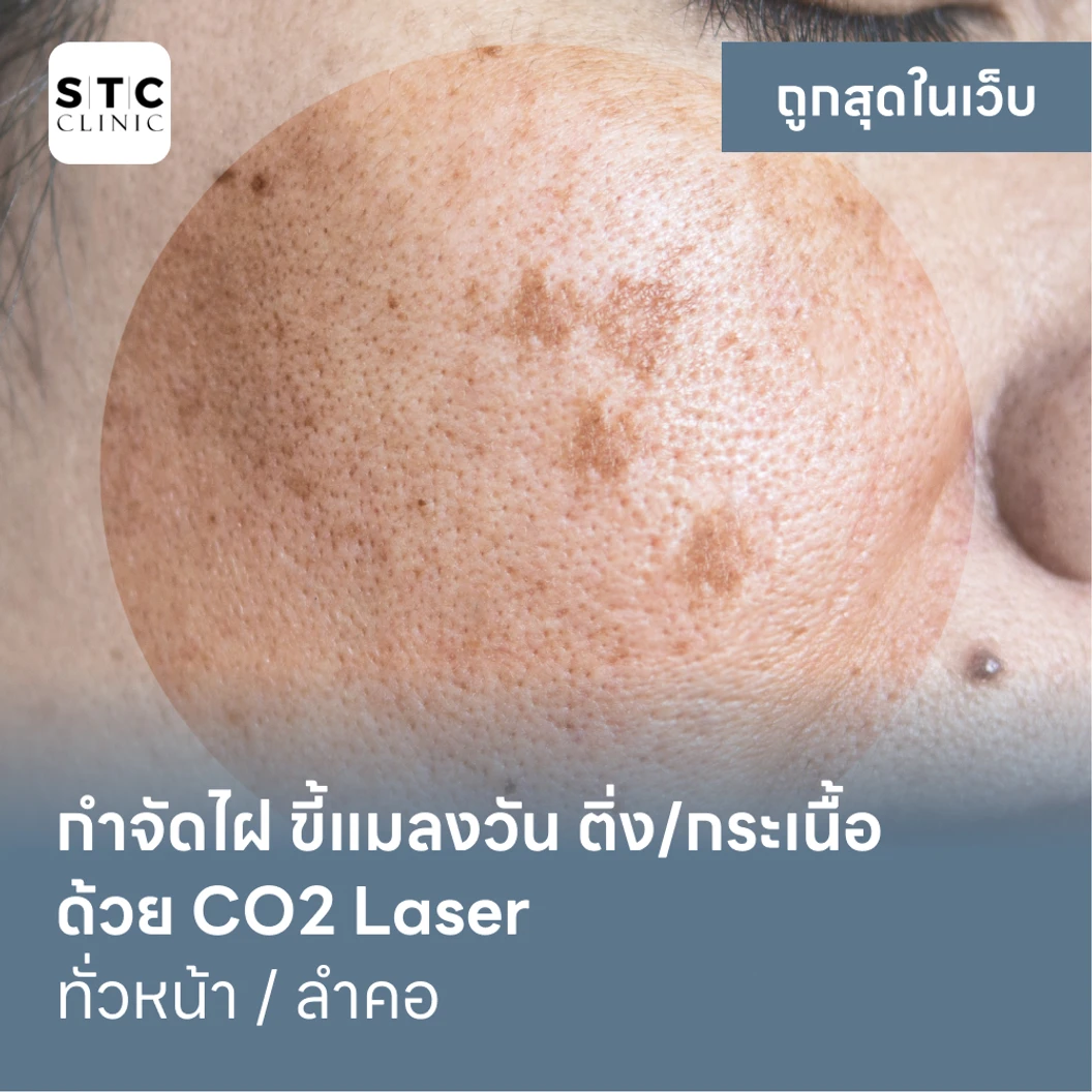 กำจัดไฝ ขี้แมลงวัน ติ่งเนื้อ กระเนื้อ ด้วย CO2 Laser ขนาดเส้นผ่านศูนย์กลางไม่เกิน 2 มม ไม่จำกัดจุดทั่วใบหน้าหรือลำคอ 1 ครั้ง แพ็กเกจ HDmall+ ที่ STC Anti-Aging & Wellness Clinic