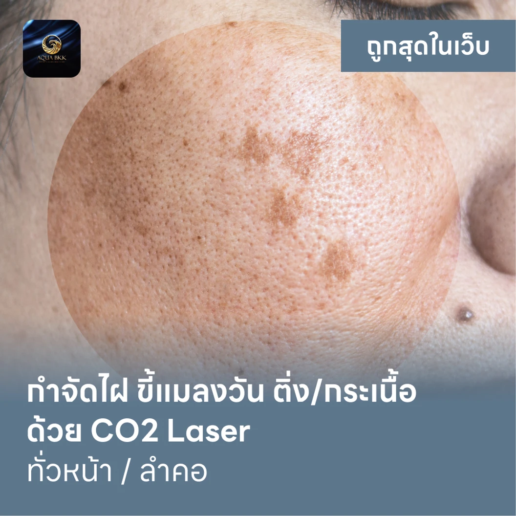 กำจัดไฝ ขี้แมลงวัน ติ่งเนื้อ กระเนื้อ ด้วย CO2 Laser ขนาดเส้นผ่านศูนย์กลางไม่เกิน 2 มม ไม่จำกัดจุดทั่วใบหน้าหรือลำคอ 1 ครั้ง แพ็กเกจ HDmall+ ที่ AQUA BKK Aesthetic & Wellness Clinic
