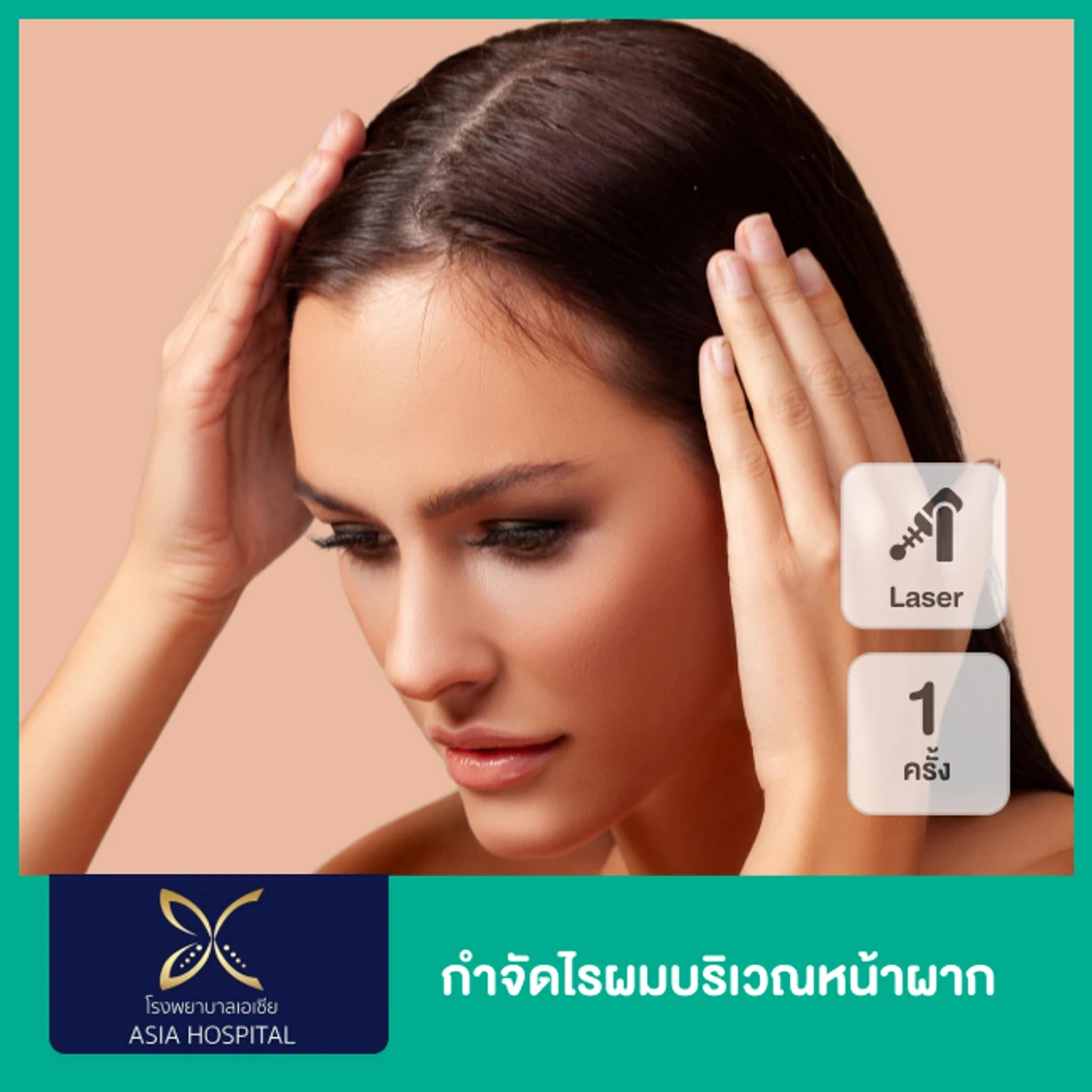กำจัดไรผมบริเวณหน้าผาก ด้วย SHR Laser 1 ครั้ง ที่ โรงพยาบาลเอเซีย