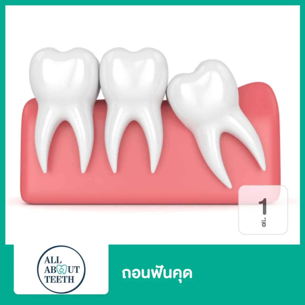 ถอนฟันคุด 1 ซี่ ที่ All About Teeth Clinic