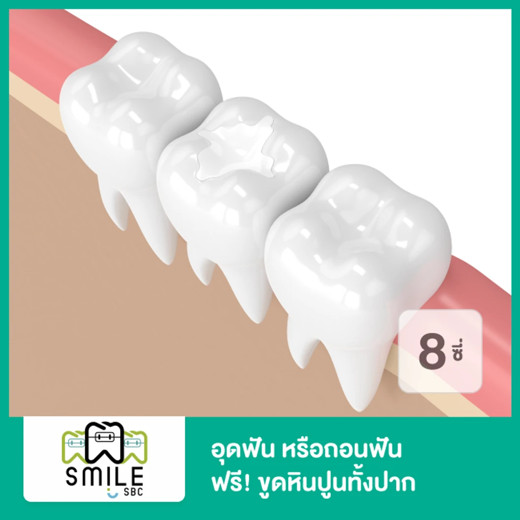 อุดฟัน หรือถอนฟัน 8 ซี่ ฟรี! ขูดหินปูนทั้งปาก ที่ SmileSBC