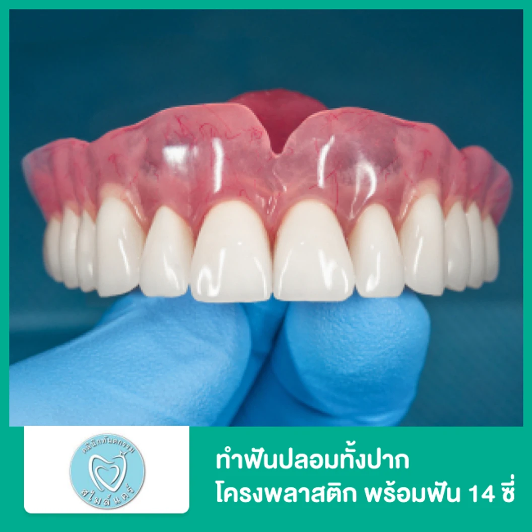 ทำฟันปลอมทั้งปาก โครงพลาสติก แผงบนหรือล่าง พร้อมฟัน 14 ซี่ ที่ คลินิกทันตกรรมสไมล์แคร์ สมุทรปราการ