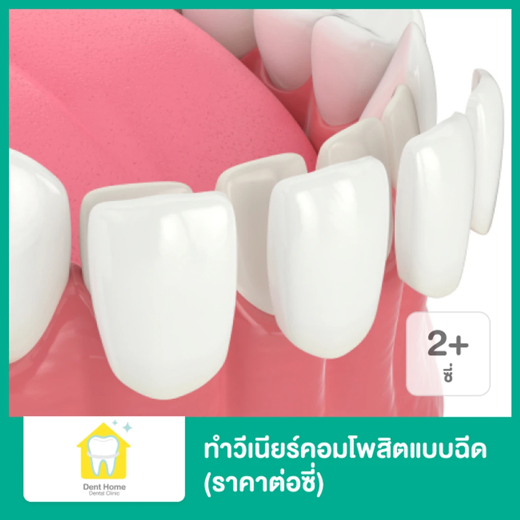 ทำวีเนียร์คอมโพสิตแบบฉีด สำหรับฟัน 2 ซี่ขึ้นไป ราคาต่อซี่ ที่ คลินิกทันตกรรมเด้นท์โฮม