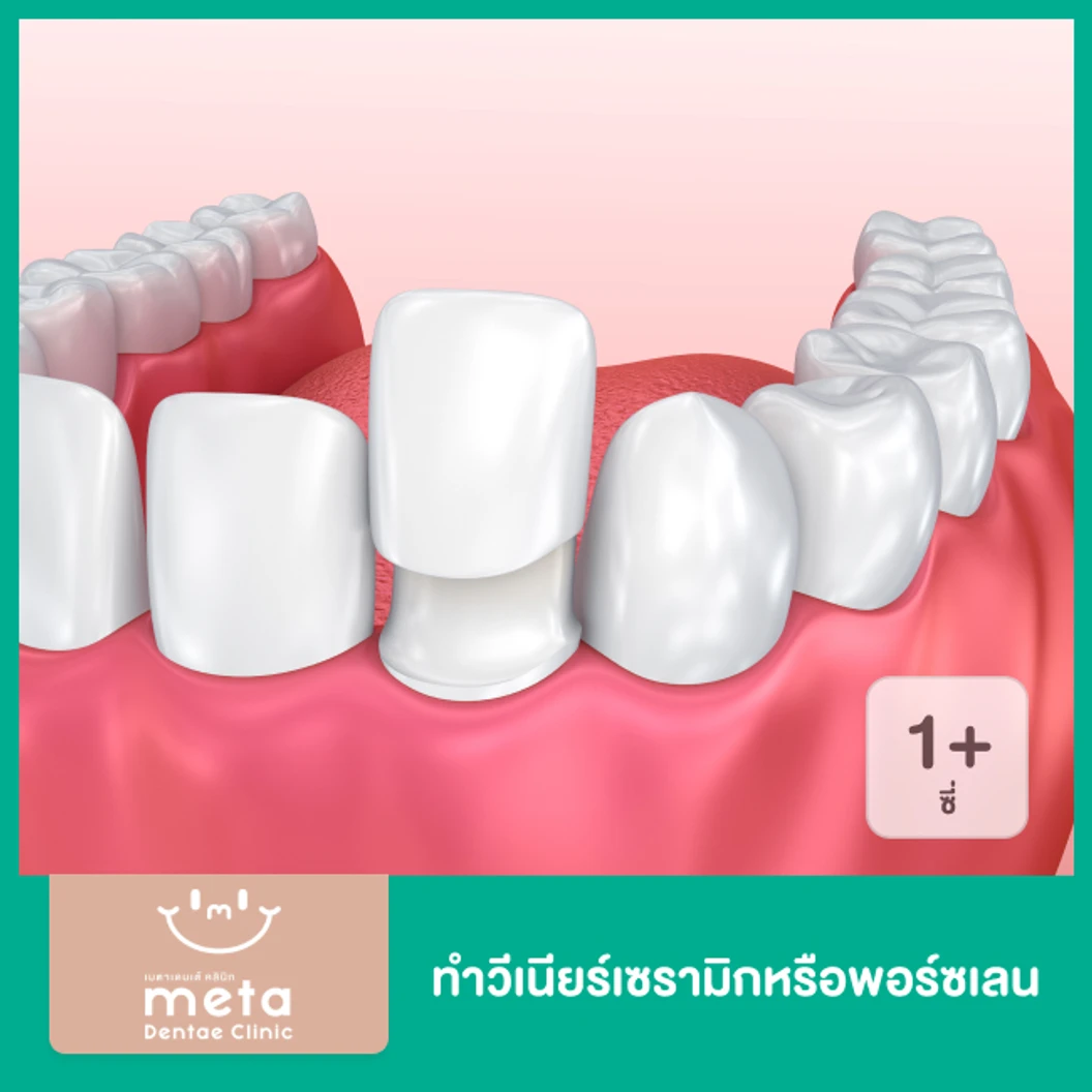 ทำวีเนียร์เซรามิกหรือพอร์ซเลน สำหรับฟัน 1 ซี่ ขึ้นไป ที่ Meta Dentae Clinic