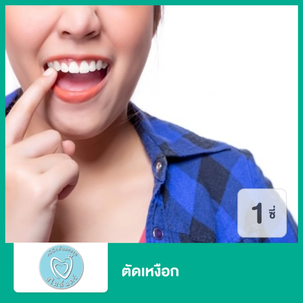 ตัดเหงือก สำหรับฟัน 1 ซี่ ที่ คลินิกทันตกรรมสไมล์แคร์ สมุทรปราการ