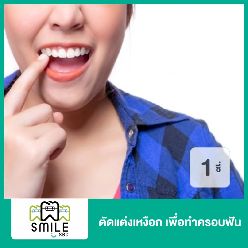 ตัดแต่งเหงือก Crown Lengthening เพื่อทำครอบฟัน สำหรับฟัน 1 ซี่ ที่ SmileSBC