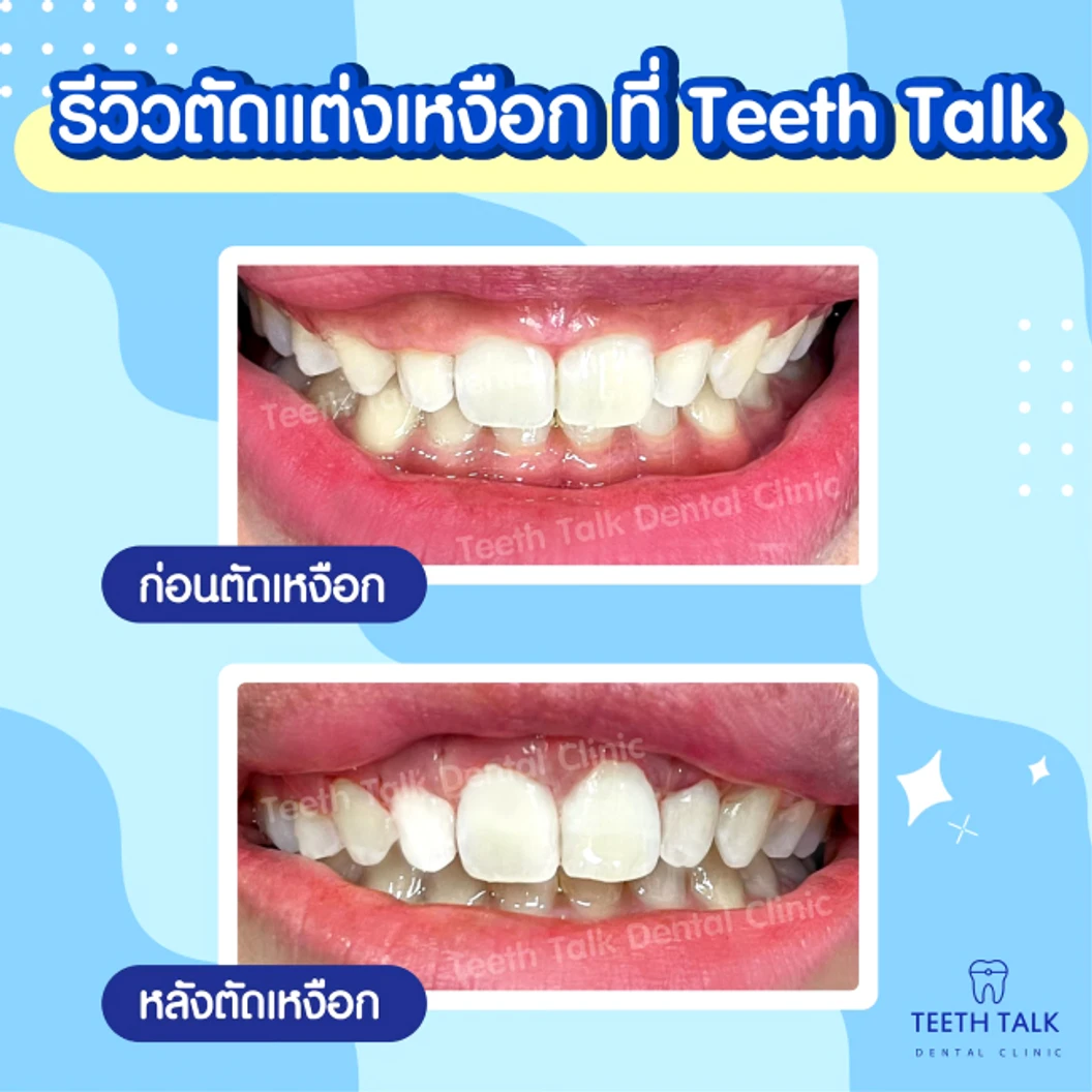 ตัดแต่งเหงือก เคสไม่กรอกระดูก สำหรับฟัน 1 ซี่ ที่ Teeth Talk Dental Clinic