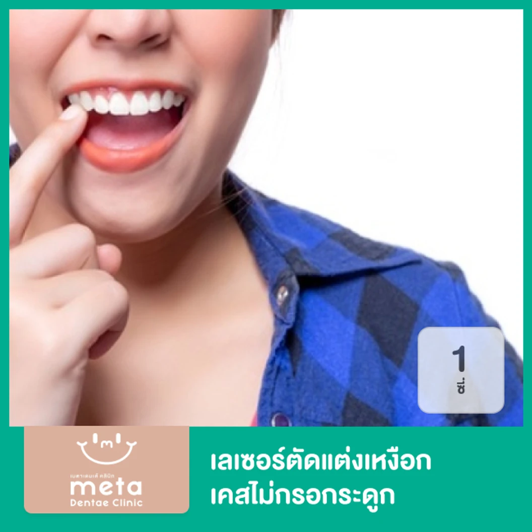 เลเซอร์ตัดแต่งเหงือก ด้วยเครื่อง Electrosurgery เคสไม่กรอกระดูก 1 ซี่ ที่ Meta Dentae Clinic