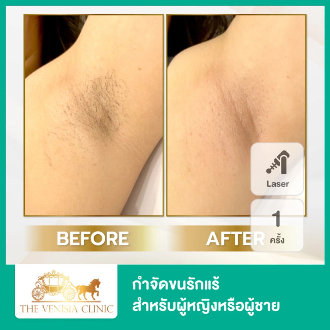 เลเซอร์ Diolaze XL กำจัดขนรักแร้ 1 ครั้ง ที่ The Venisia Clinic