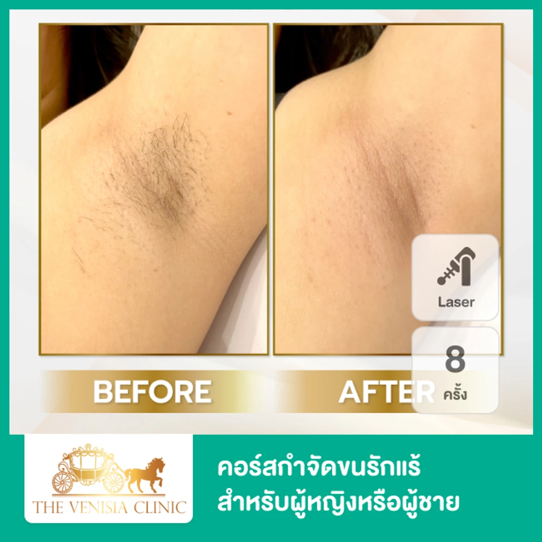 คอร์สเลเซอร์ Diolaze XL กำจัดขนรักแร้ 8 ครั้ง ที่ The Venisia Clinic