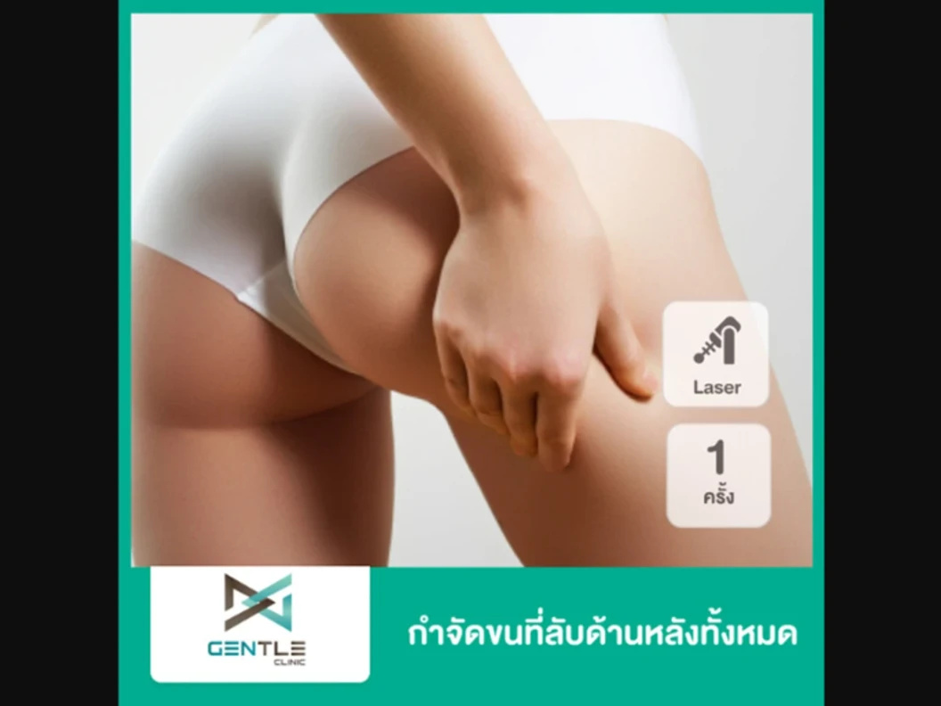 กำจัดขนบริเวณรอบรูทวารหนัก O Line ด้วยเลเซอร์ Trio Diode 1 ครั้ง สำหรับผู้หญิงหรือผู้ชาย ที่ Gentle Clinic