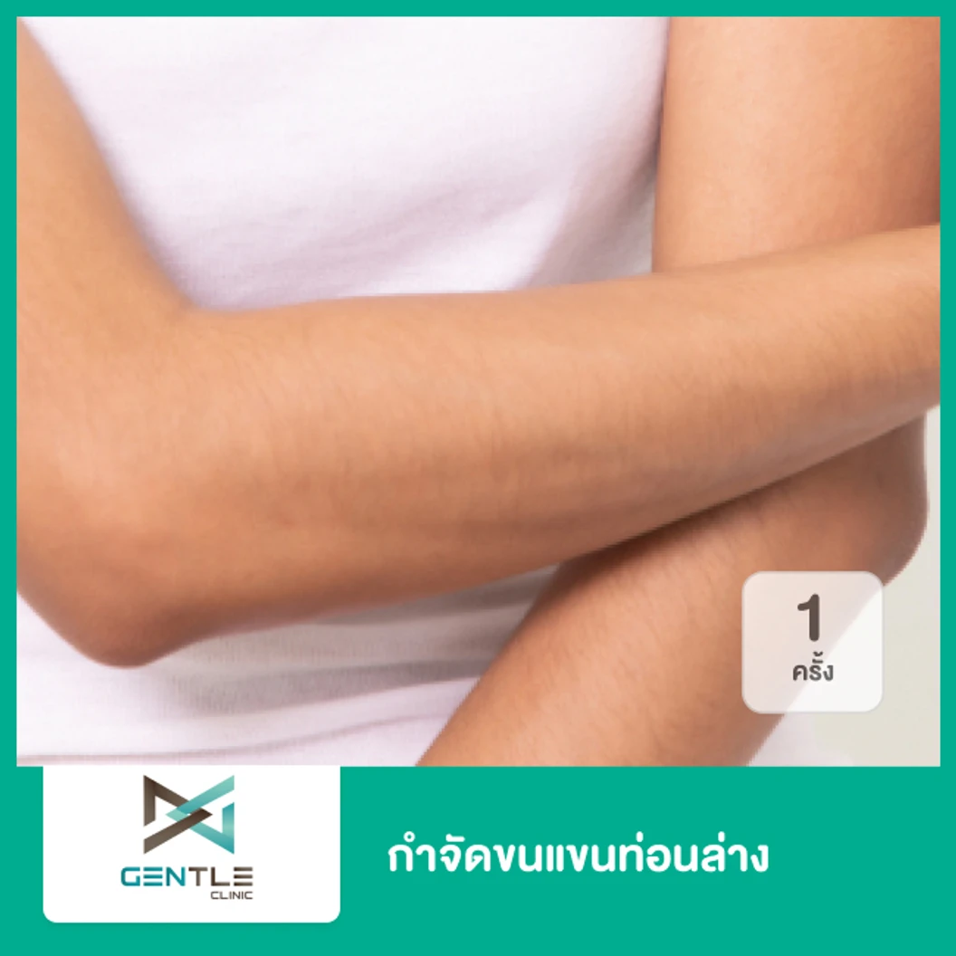 กำจัดขนแขนท่อนล่าง ด้วยเลเซอร์ Trio Diode 1 ครั้ง ที่ Gentle Clinic