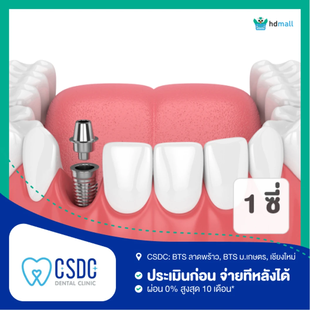 ทำรากฟันเทียม ยี่ห้อ Astra Tech 1 ซี่ ที่ CSDC